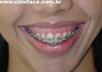 Sorriso inicial - Clínica Cliniface