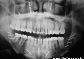 Raio X panorâmico após cirurgia - Clínica Cliniface