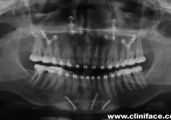 Raio x panorâmico final - Clínica Cliniface