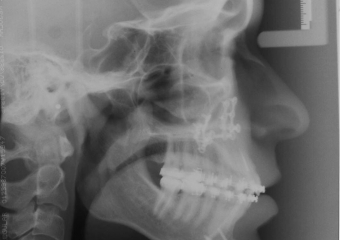 Telerradiografia após cirúrgica - Clínica Cliniface