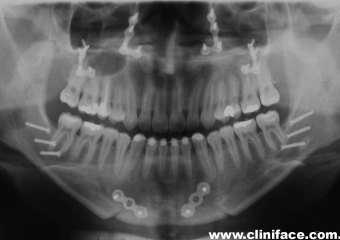 Raio x panorâmico final - Clínica Cliniface