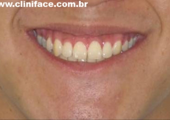 Sorriso após a remoção do aparelho - Clínica Cliniface