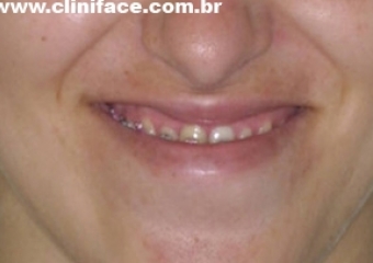 Sorriso inicial    - Clínica Cliniface