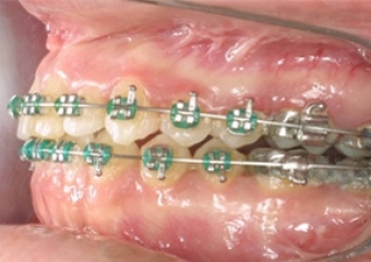 Imagem mordida após a cirurgia - Clínica Cliniface