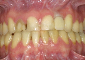  Imagem inicial com ausencia do incisivo lateral esquerdo - Clínica Cliniface