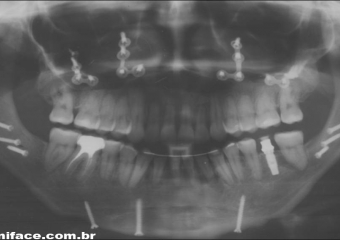Raio x panorâmico final - Clínica Cliniface