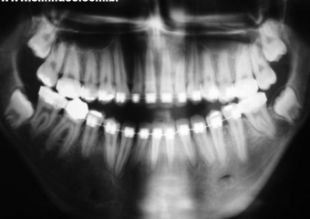 Raio x panorâmico inicial - Clínica Cliniface