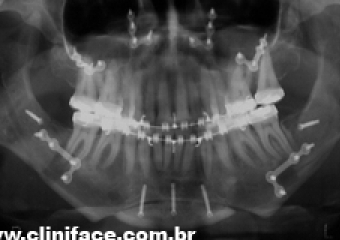  Raio x panorâmico após a cirurgia - Clínica Cliniface