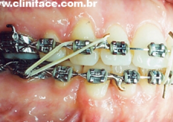 Mordida após cirurgia - Clínica Cliniface