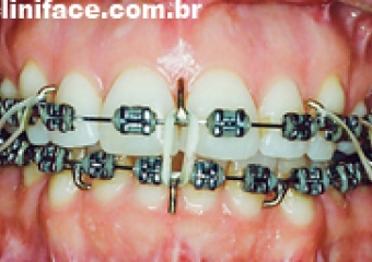 Imagem após a cirurgia - Clínica Cliniface