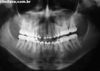 Raio x panorâmico inicial - Clínica Cliniface