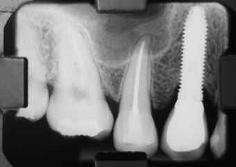 Rx e imagem da prótese fixa em porcelana  sobre implante - Clínica Cliniface