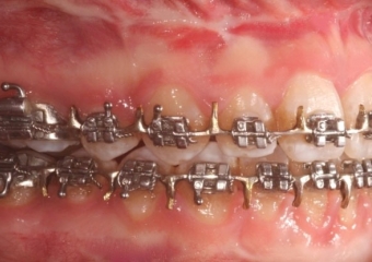 Mordida após a cirurgia - Clínica Cliniface