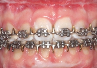 Mordida após a cirurgia  - Clínica Cliniface