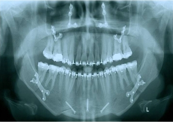 Raio x após a cirurgia - Clínica Cliniface