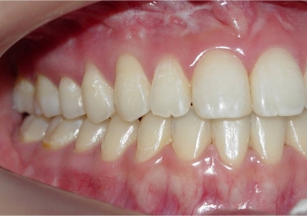 Mordida após a remoção do aparelho - Clínica Cliniface