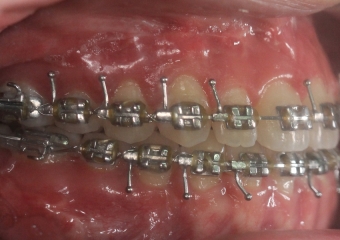 Mordida após a cirurgia - Clínica Cliniface