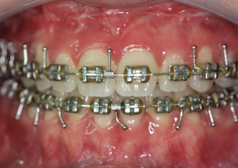 Mordida após a cirurgia - Clínica Cliniface