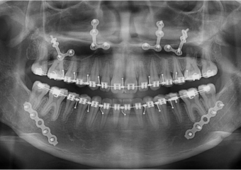 Raio X após a cirurgia - Clínica Cliniface