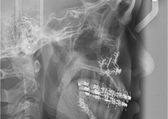 Telerradiografia após a cirurgia - Clínica Cliniface