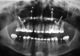Raio x panorâmico final - Clínica Cliniface