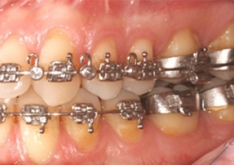 Mordida após a cirurgia - Clínica Cliniface