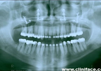 Raio X panorâmico final - Clínica Cliniface