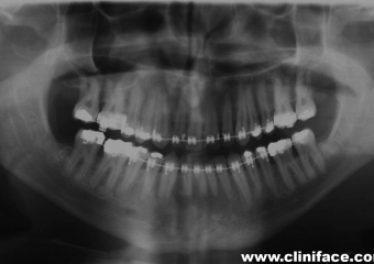 Raio x panorâmico inicial - Clínica Cliniface
