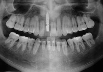 Raio X  com implante e prótese provisória - Clínica Cliniface