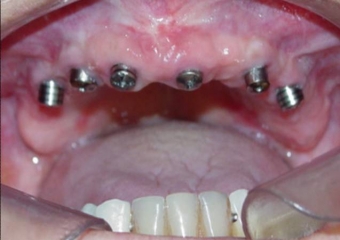 Imagem dos Implantes Superiores Instalados - Clínica Cliniface