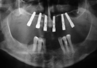 Raio X dos Implantes Instalados - Clínica Cliniface