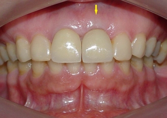 Prótese fixa em porcelana sobre implante Cone Morse - Clínica Cliniface