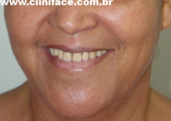 Sorriso inicial - Clínica Cliniface