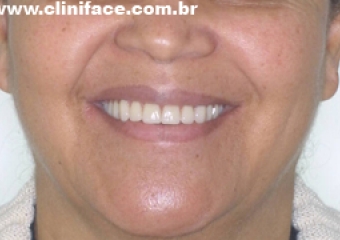 Sorriso com prótese fixa em resina terminado em junho de 2010 - Clínica Cliniface