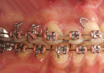 Mordida após a cirurgia - Clínica Cliniface