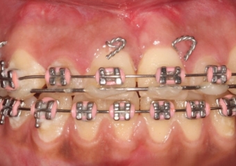 Mordida após a cirurgia  - Clínica Cliniface