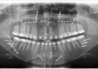 Raio - x após a cirurgia realizada em 2016 - Clínica Cliniface