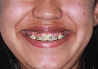 Sorriso Inicial - Clínica Cliniface