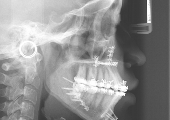 Telerradiografia após a cirurgia - Clínica Cliniface