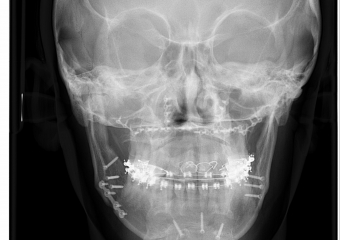 Telerradiografia Frontal após a cirurgia - Clínica Cliniface