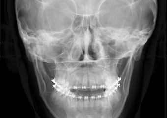 Telerradiografia Frontal Inicial - Clínica Cliniface