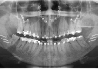 Raio x após a cirurgia - Clínica Cliniface