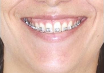 Sorriso incial - Clínica Cliniface