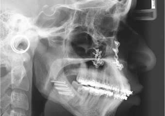 Telerradiografia após a cirurgia - Clínica Cliniface