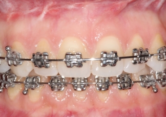 Mordida após a cirurgia - Clínica Cliniface