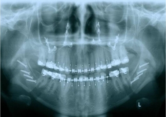 Raio x após a cirurgia - Clínica Cliniface