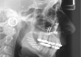 Telerradiografia após a cirurgia - Clínica Cliniface