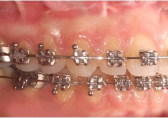 Mordida após a cirurgia - Clínica Cliniface