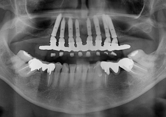 Raio X  com a prótese fixa em resina, sobre implantes Cone Morse - Clínica Cliniface