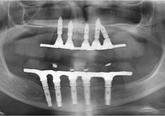 Raio X das próteses sobre implantes superiores e inferiores - Clínica Cliniface